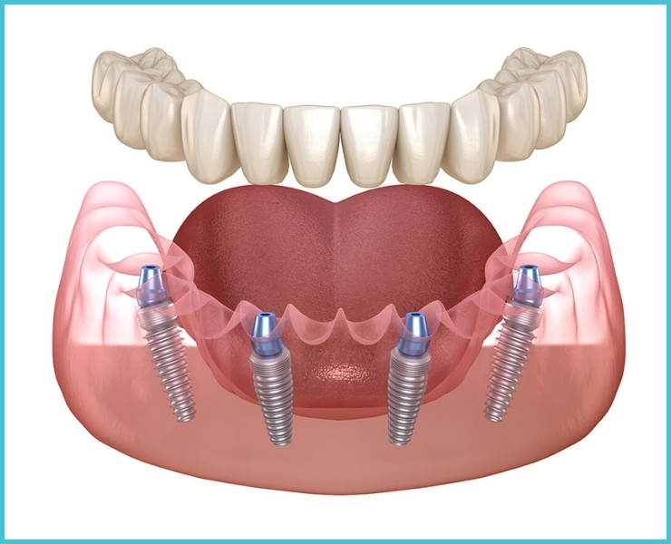 all on 4 implant