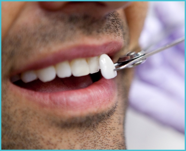 dental veneers