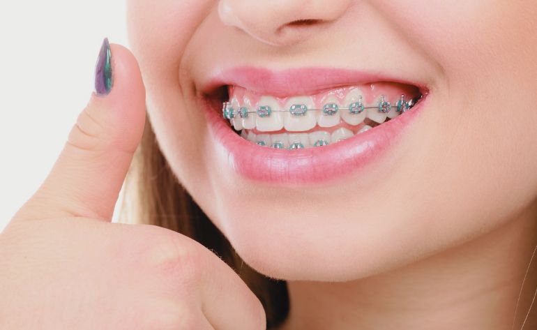 How to Care for Your Braces